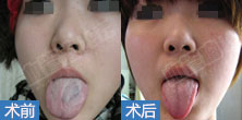 成年舌部海绵状血管瘤病例