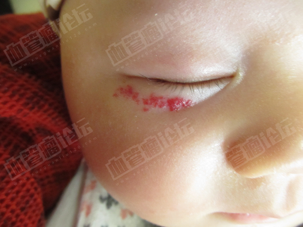 小孩眼部草莓状血管瘤治疗日记