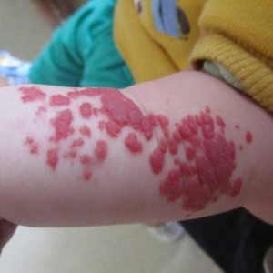 宝宝手臂上的红斑有些凸出请问是血管瘤吗？_血管瘤论坛-中国血管瘤患者之家